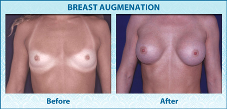 vps-ba-2-breast-enlargment-450