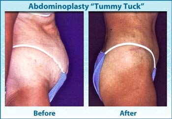 vps-ba-vert-2-abdominoplasty1