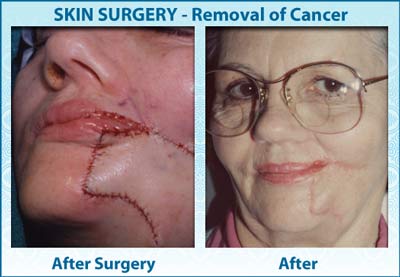 vps-ba-vert-2-skin-surgery-cancer