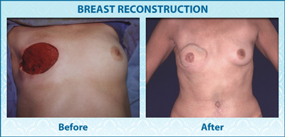 vps-ba-2-breast-reconstruction