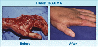 vps-ba-2-hand-trauma